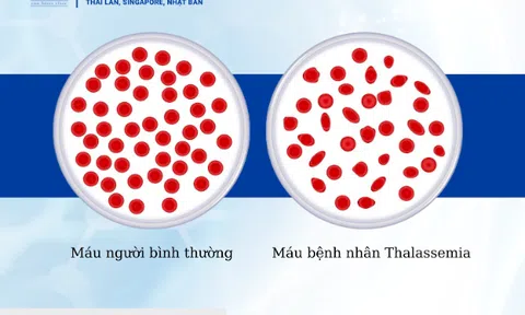 Điều trị Thalassemia bằng tế bào gốc